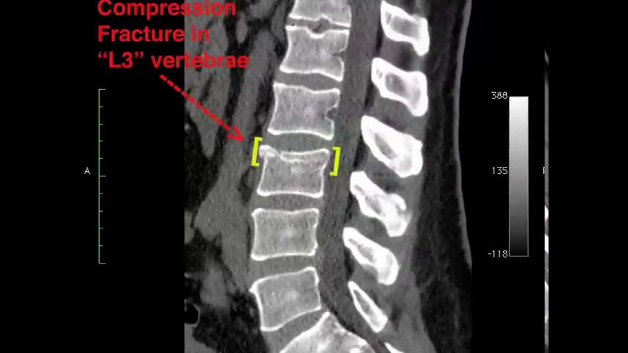 Reduced Spinal Compression