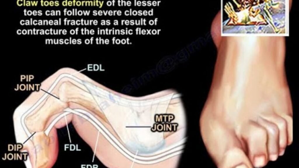 Hammer Toe Exercises