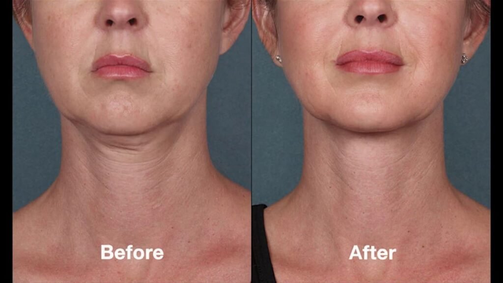 Exercise After Botox