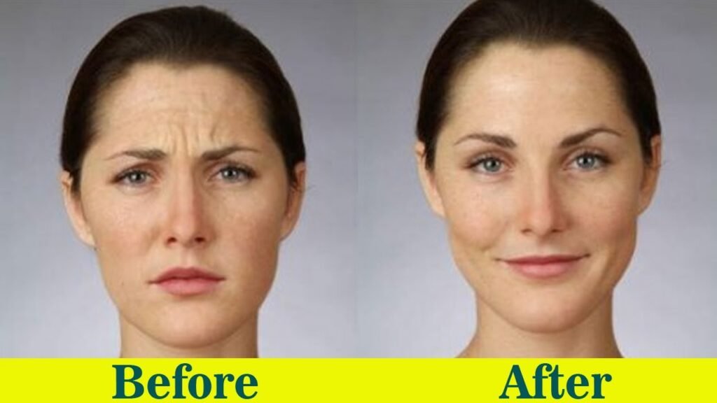 Exercise After Botox